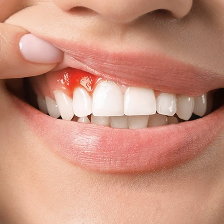 Răng bọc sứ có mùi hôi do bệnh lý răng miệng chưa được điều trị triệt để